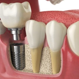 Un implant dentaire s'intègre à la mâchoire